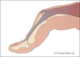 Image result for Elson Extensor Tendon Test