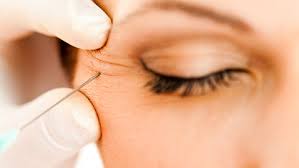 Como reza el dicho, no es oro todo lo que reluce, el botox tiene una serie de efectos secundarios dañinos para la salud de tu piel que debes tener muy en cuenta antes de hacerte el tratamiento rejuvenecedor. Toxina Botulinica Usos Efectos Y Contraindicaciones Rpp Noticias