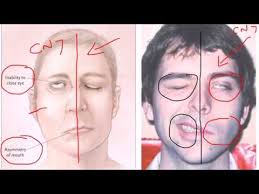 They may include muscle twitching, weakness, or total loss of the ability to move one, and in rare cases, both sides of the face. Bells Palsy Youtube