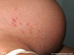Image result for pruritic urticarial papules and plaques of pregnancy