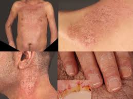 Image result for Connective Tissue Disorder