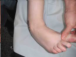 Image result for Talar Tilt