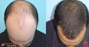 افضل مراكز زراعة الشعر فى الاسكندرية واسعار كل مركز