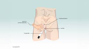 Image result for Pudendal Block