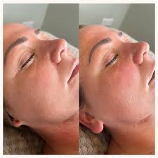 Image result for Dry Skin Management