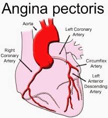 Pin On Heart And Angina Diseases