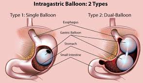 Pin On Bariatric Surgery Follow Up