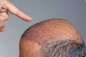 أسعار ومراكز زراعة الشعر في السعودية 1441 موقع محتوى