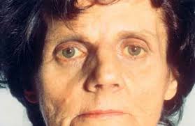 A jaundiced patient with yellow sclera