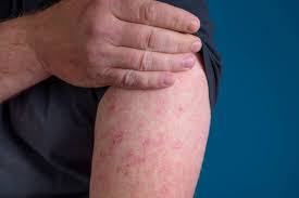 Image result for erysipel photos)