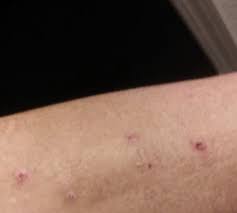 I've put prid on painful ingrown hair bumps/boils and cystic pimples. Ingrown Hairs Help Babycenter