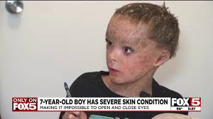 Donations pour in for Las Vegas boy with severe skin condition