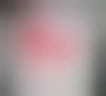 Image result for flegmona pedis)