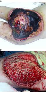 Necrotizing fasciitis is a life threatening condition. Necrotizing Fasciitis In Children Diagnostic And Therapeutic Aspects Journal Of Pediatric Surgery