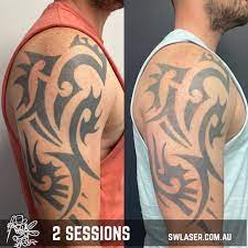 Or if you've already removed a tattoo, how many sessions did it take? Facebook