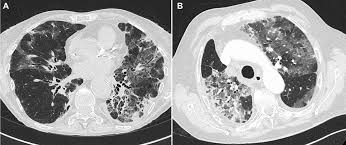 Image result for Pulmonary Intoxicant