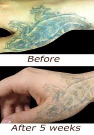 Laserless Tattoo Removal Natural Tattoo Removal Tattoo Removal Faded Tattoo