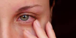 Bindehautentzundung Konjunktivitis Heilpraxis