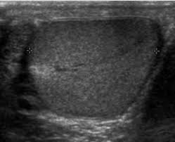 Testicular tumors are usually diagnosed at ultrasonography (us) and are staged at computed tomography (ct) or magnetic resonance (mr) imaging. Scrotal Ultrasound Wikipedia