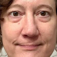 Fundraiser by Linda Noonan : Help Barbara get the surgery she needs