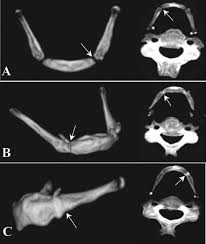 Image result for Hyoid Bone