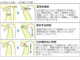 顎関節症２ - 伊勢リハ☆ブログ - 学校法人協栄学園