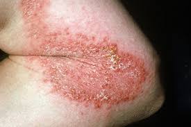 Babies get mottled skin due to their sympathetic nervous system that isn't regulated yet. Pictures Of Blotchy Skin Rosacea Hives Psoriasis And More
