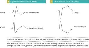 Left Bundle Branch Block Lbbb Ecg Criteria Causes Management Ecg Echo In 2020 Bundle Branch Block Conduction Branch