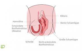 Erst sah es so aus, als ob es ein geplatztes pickelchen wäre, so ein offener minikrater. Bartholinitis Ursachen Symptome Therapie Onmeda De