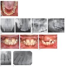Check spelling or type a new query. 34 Supernumerary Teeth Pocket Dentistry