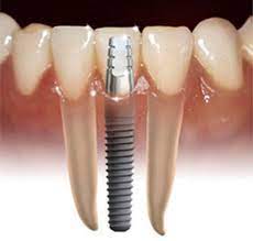 We did not find results for: How To Get Free Dental Implants Hubpages