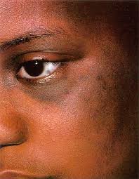 Image result for melanosis sclera