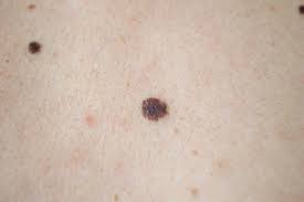 If you buy through links on this page, we may earn a small. The Types Of Skin Cancer