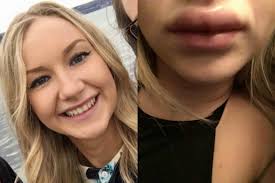 L'intervento chirurgico alla bocca va male, si ritrova con le labbra gonfie  e livide