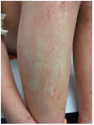Image result for Dermatographism