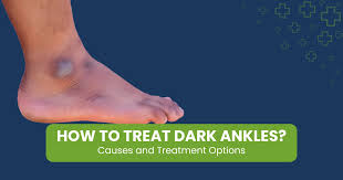 Image result for brown patches on the feet