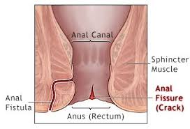 Penyebab yang paling sering terjadi adalah karena feses yang besar dan keras yang keluar melalui anus. 38 Perbedaan Fisura Ani Dan Fistula Ani Yang Harus Diperhatikan Dokterpencernaan Com