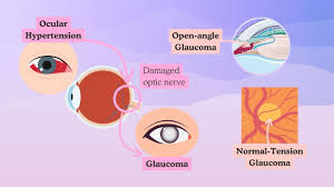 Image result for Intraocular Pressure