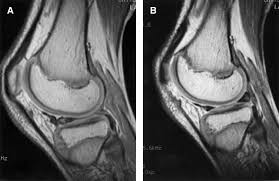 My lateral meniscus tear caused random extreme pain as the loose piece would catch in the knee joint and i lost support with that leg. Locked Knee Caused By Meniscal Subluxation Magnetic Resonance Imaging And Arthroscopic Verification Arthroscopy