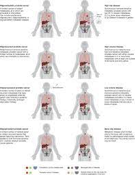 Overall, 74,826 patients with metastatic pca were identified. A Combined Biological And Clinical Rationale For Evaluating Metastasis Directed Therapy In The Management Of Oligometastatic Prostate Cancer Radiotherapy And Oncology