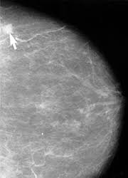 A mammogram can show breast changes such as calcifications, masses, or other symptoms that might be cancer. Mammography
