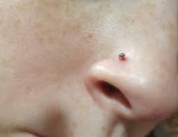 Nose Piercing Bump Help I Got It Done 6 Weeks Ago And It Was Healing Great All Of A Sudden It Formed This Red Blood Bump I Ve Been Cleaning It Everyday 1 2