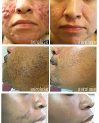 Moises Acevedo (@mr_dermis) • Instagram photos and videos