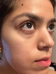 Dark circle and acne scar treatments