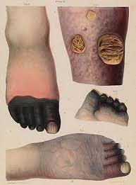 The condition can affect any general symptoms of gangrene include: Gangrene Wikipedia
