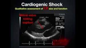 Intussusception | learn about it and test your skills on aliemu. Rush Rapid Ultrasound In Shock Youtube