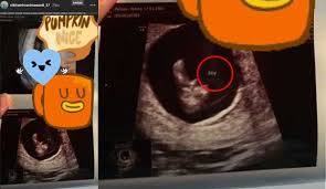 Cara membaca hasil usg di trimester ket… Pamer Foto Hasil Usg Nikita Mirzani Ungkap Jenis Kelamin Calon Bayi