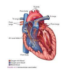 Image result for Endocardial Cushion Defect