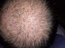 Precauzioni e cure · non bere alcolici per 5 giorni · ridurre quanto più possibile la sudorazione · evitare di urtare e . Consigli Terapia Post Trapianto Capelli