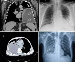 Image result for Lung Abscess